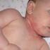 Pelenski osip u novorođenčadi: uzroci, liječenje i prevencija